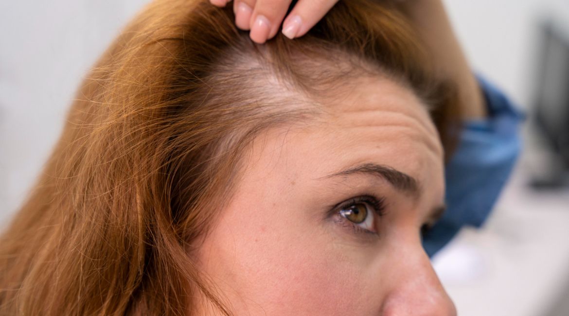 برای جلوگیری از ریزش مو چه بخوریم؟