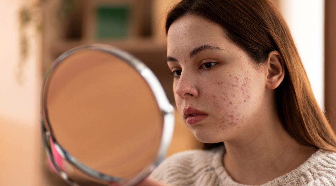 علت جوش صورت چیست و چگونه آن را درمان کنیم؟ راهنمای کامل درمان آکنه